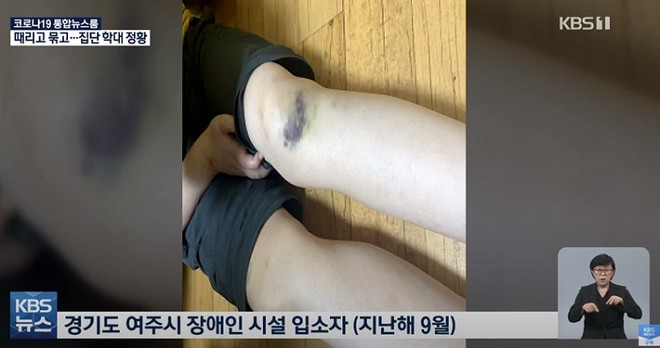 여주 '라파엘의 집'에서 사는 장애인 입소자의 학대당한 흔적. (이미지 출처 = KBS News 유튜브 동영상 갈무리)<br>